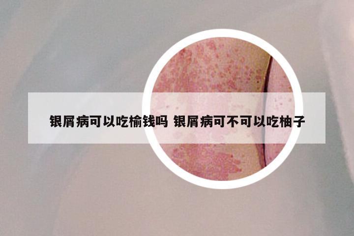 银屑病可以吃榆钱吗 银屑病可不可以吃柚子
