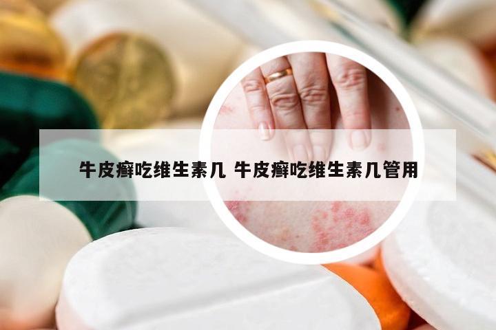 牛皮癣吃维生素几 牛皮癣吃维生素几管用