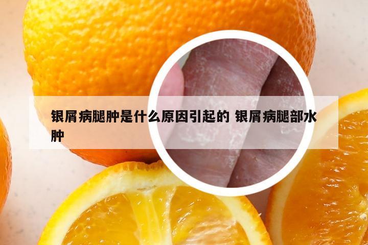 银屑病腿肿是什么原因引起的 银屑病腿部水肿