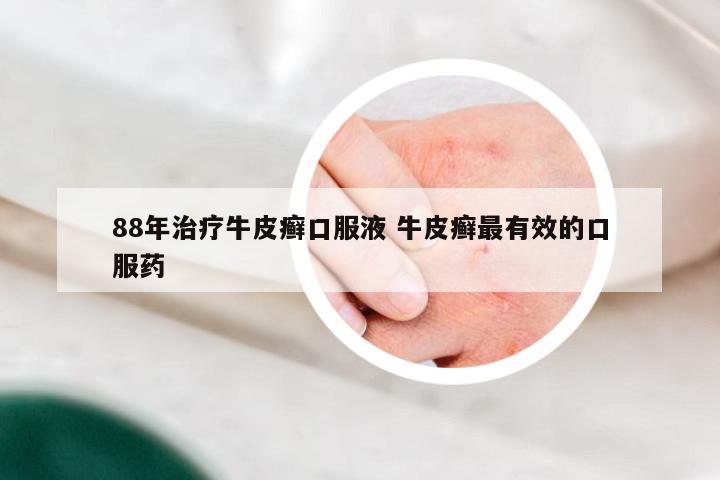 88年治疗牛皮癣口服液 牛皮癣最有效的口服药