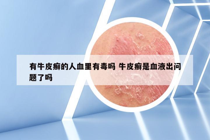 有牛皮癣的人血里有毒吗 牛皮癣是血液出问题了吗