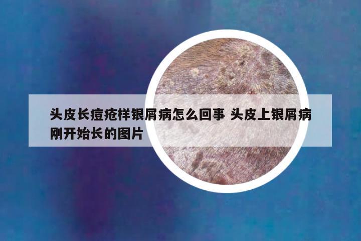 头皮长痘疮样银屑病怎么回事 头皮上银屑病刚开始长的图片