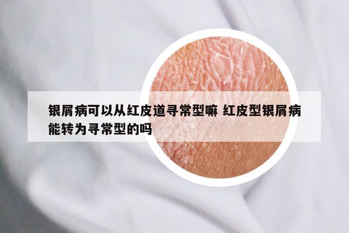 银屑病可以从红皮道寻常型嘛 红皮型银屑病能转为寻常型的吗