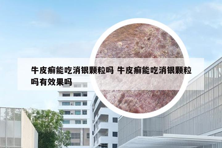 牛皮癣能吃消银颗粒吗 牛皮癣能吃消银颗粒吗有效果吗