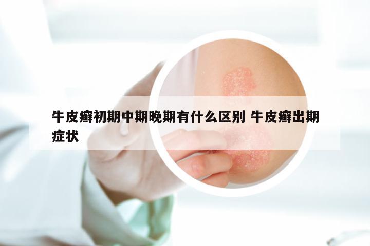 牛皮癣初期中期晚期有什么区别 牛皮癣出期症状