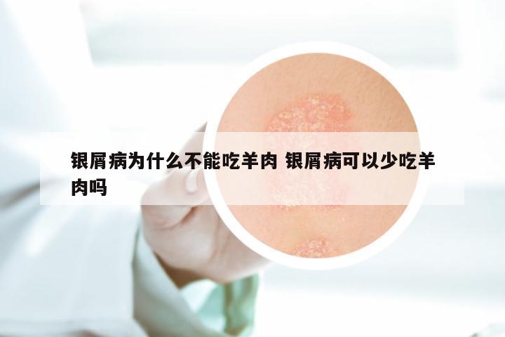 银屑病为什么不能吃羊肉 银屑病可以少吃羊肉吗
