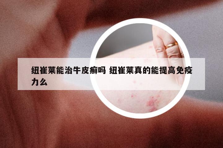 纽崔莱能治牛皮癣吗 纽崔莱真的能提高免疫力么