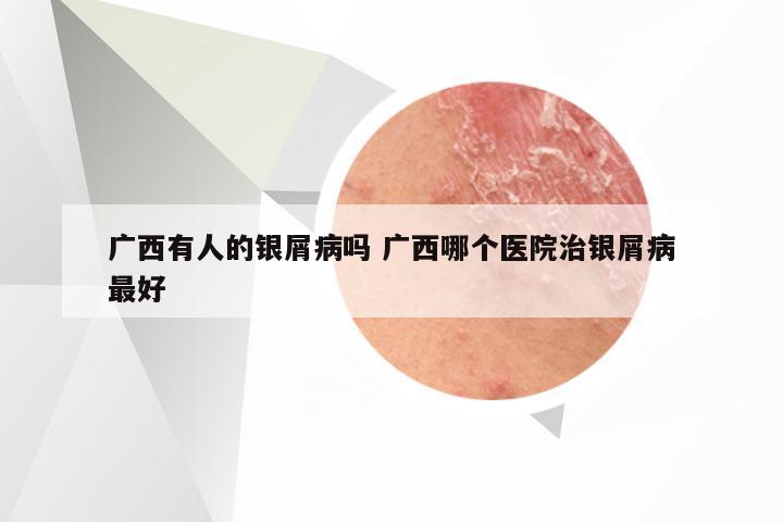 广西有人的银屑病吗 广西哪个医院治银屑病最好