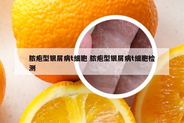 脓疱型银屑病t细胞 脓疱型银屑病t细胞检测