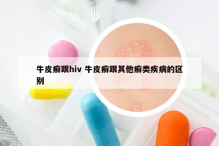 牛皮癣跟hiv 牛皮癣跟其他癣类疾病的区别