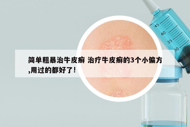简单粗暴治牛皮癣 治疗牛皮癣的3个小偏方,用过的都好了!