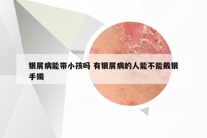 银屑病能带小孩吗 有银屑病的人能不能戴银手镯
