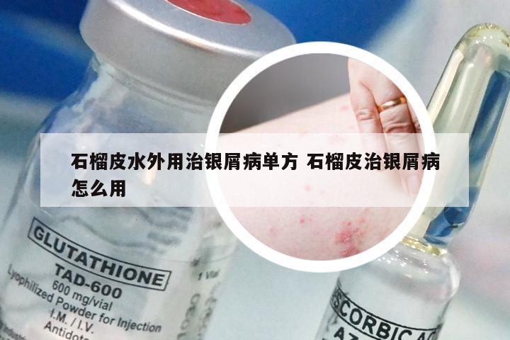 石榴皮水外用治银屑病单方 石榴皮治银屑病怎么用