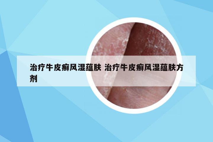 治疗牛皮癣风湿蕴肤 治疗牛皮癣风湿蕴肤方剂