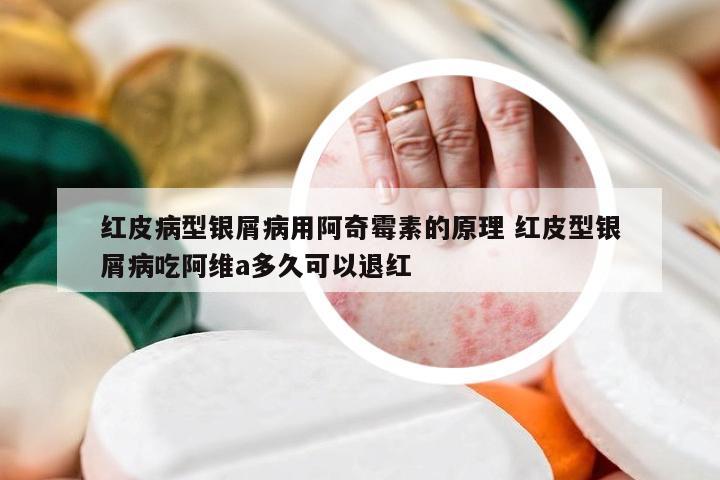 红皮病型银屑病用阿奇霉素的原理 红皮型银屑病吃阿维a多久可以退红