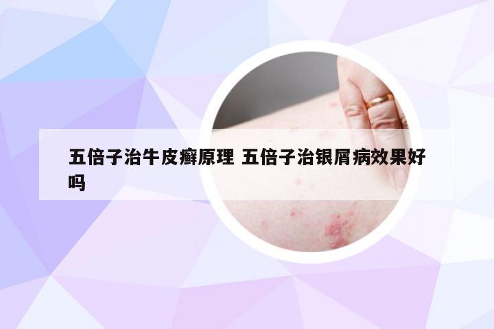 五倍子治牛皮癣原理 五倍子治银屑病效果好吗