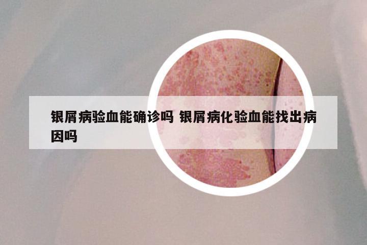银屑病验血能确诊吗 银屑病化验血能找出病因吗