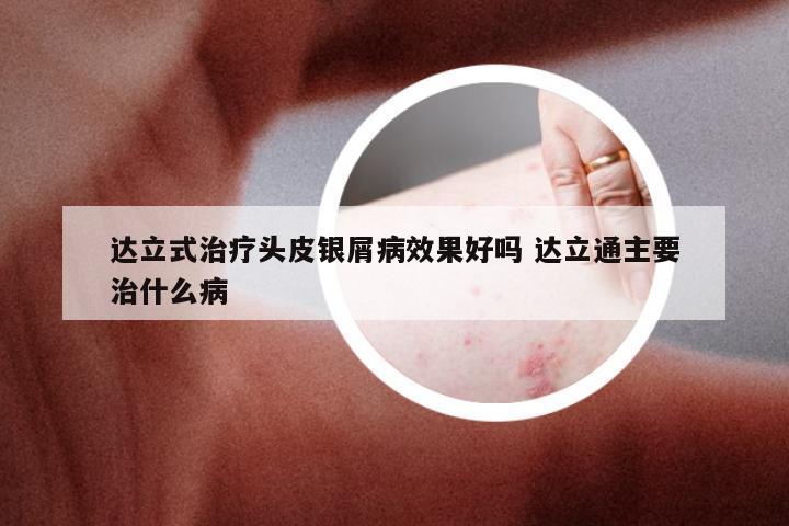 达立式治疗头皮银屑病效果好吗 达立通主要治什么病