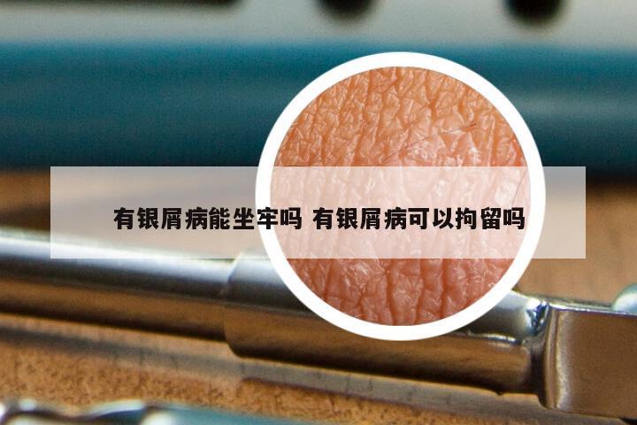 有银屑病能坐牢吗 有银屑病可以拘留吗