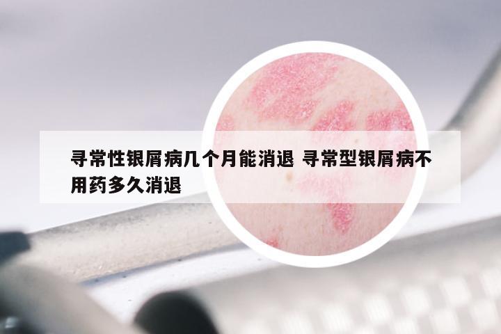 寻常性银屑病几个月能消退 寻常型银屑病不用药多久消退