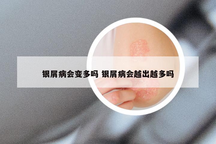 银屑病会变多吗 银屑病会越出越多吗
