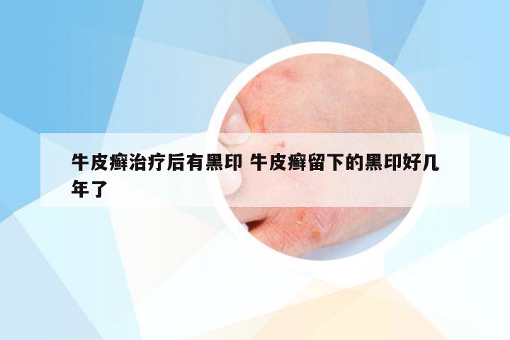 牛皮癣治疗后有黑印 牛皮癣留下的黑印好几年了
