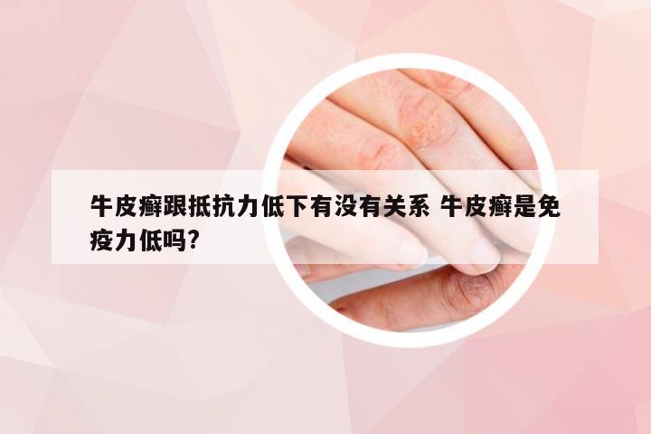 牛皮癣跟抵抗力低下有没有关系 牛皮癣是免疫力低吗?