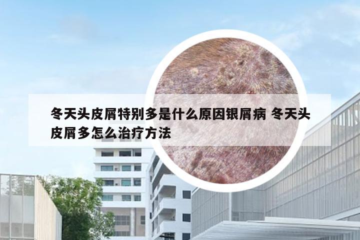 冬天头皮屑特别多是什么原因银屑病 冬天头皮屑多怎么治疗方法