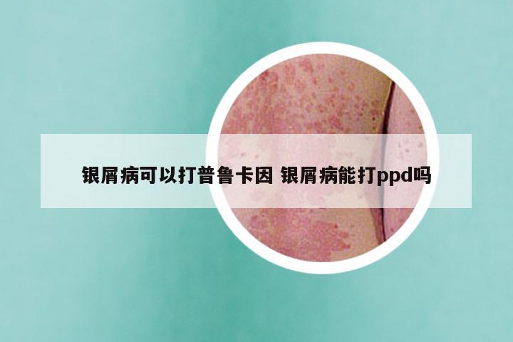 银屑病可以打普鲁卡因 银屑病能打ppd吗
