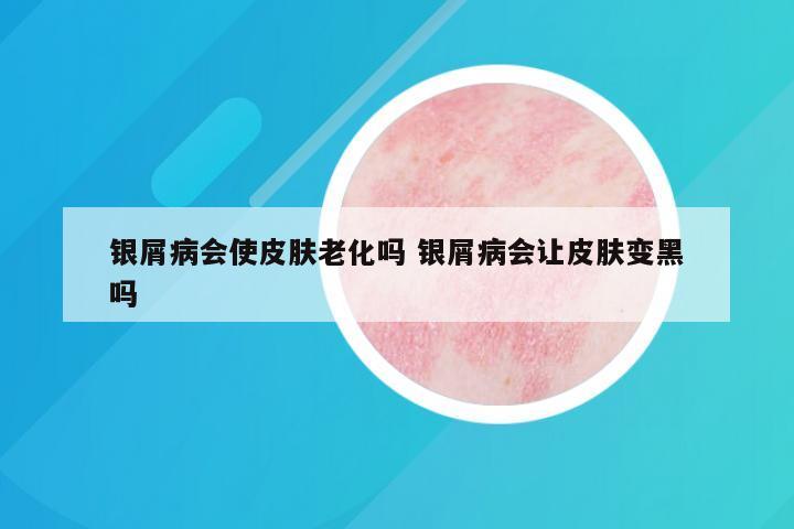 银屑病会使皮肤老化吗 银屑病会让皮肤变黑吗