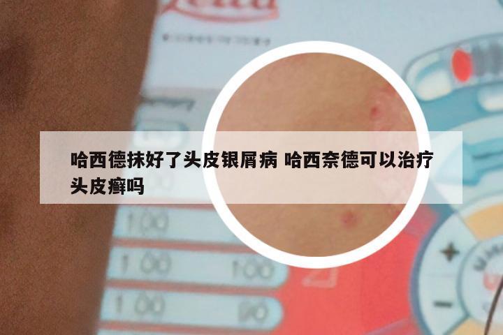 哈西德抹好了头皮银屑病 哈西奈德可以治疗头皮癣吗