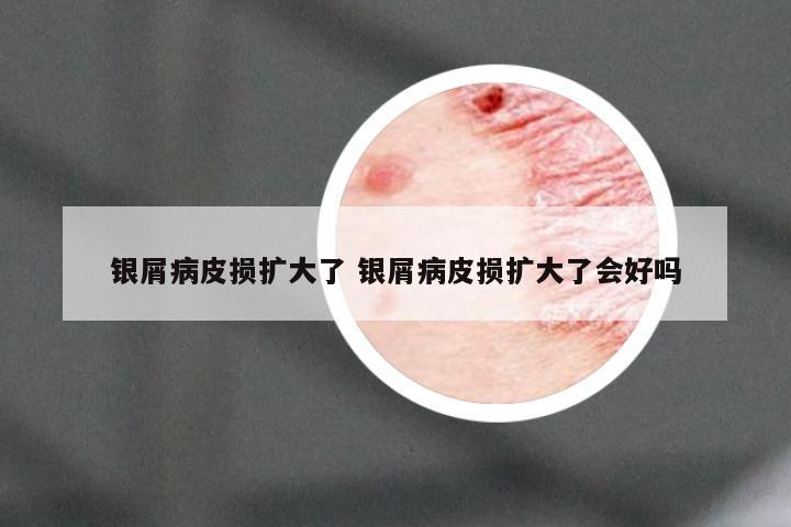 银屑病皮损扩大了 银屑病皮损扩大了会好吗