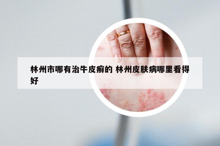 林州市哪有治牛皮癣的 林州皮肤病哪里看得好