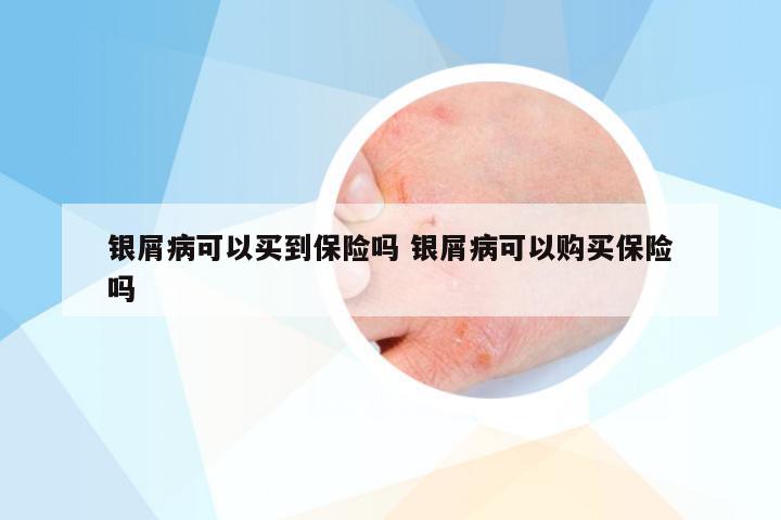 银屑病可以买到保险吗 银屑病可以购买保险吗