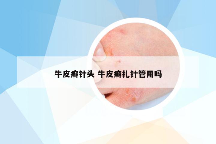 牛皮癣针头 牛皮癣扎针管用吗