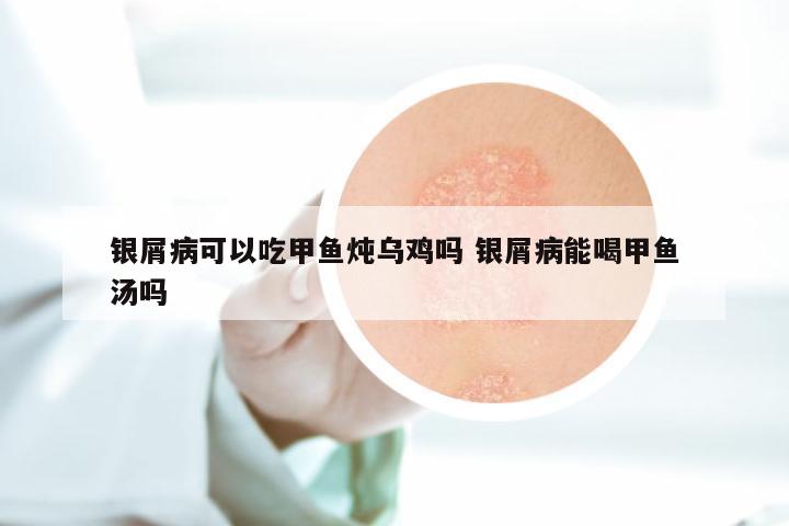 银屑病可以吃甲鱼炖乌鸡吗 银屑病能喝甲鱼汤吗