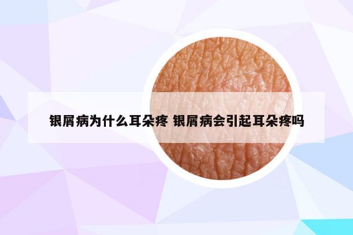 银屑病为什么耳朵疼 银屑病会引起耳朵疼吗