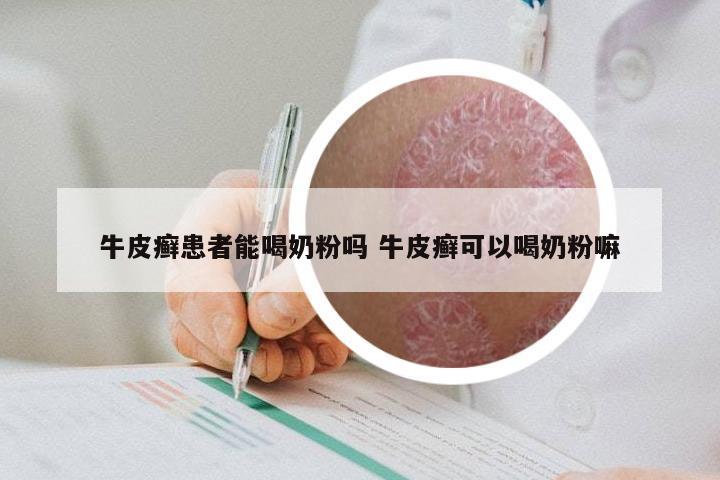 牛皮癣患者能喝奶粉吗 牛皮癣可以喝奶粉嘛