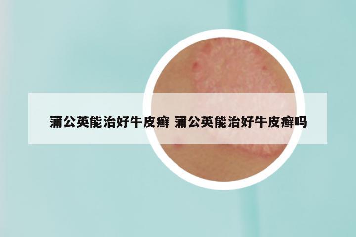 蒲公英能治好牛皮癣 蒲公英能治好牛皮癣吗