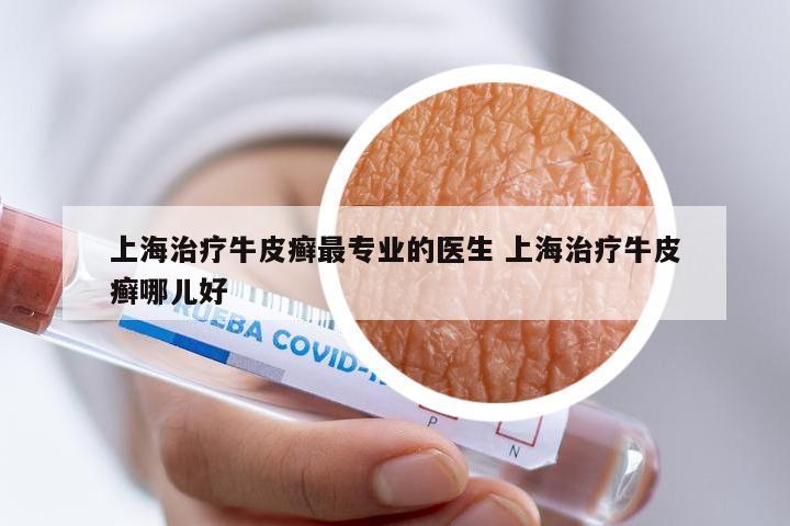 上海治疗牛皮癣最专业的医生 上海治疗牛皮癣哪儿好