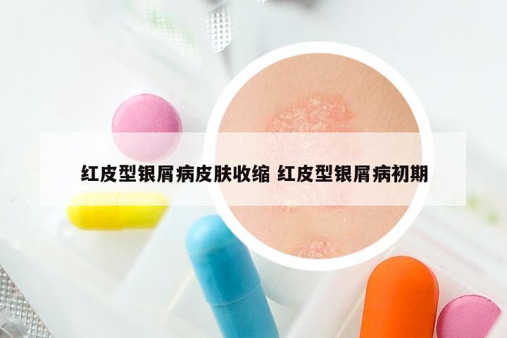 红皮型银屑病皮肤收缩 红皮型银屑病初期