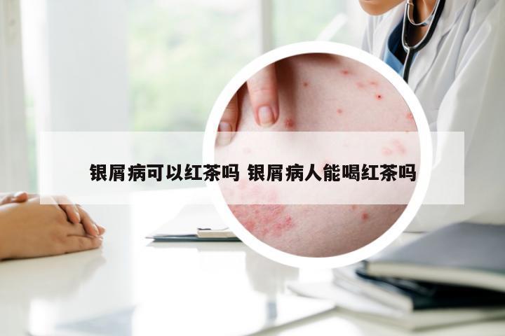 银屑病可以红茶吗 银屑病人能喝红茶吗