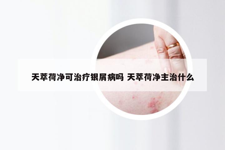 天萃荷净可治疗银屑病吗 天萃荷净主治什么