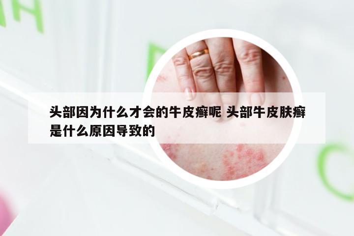 头部因为什么才会的牛皮癣呢 头部牛皮肤癣是什么原因导致的