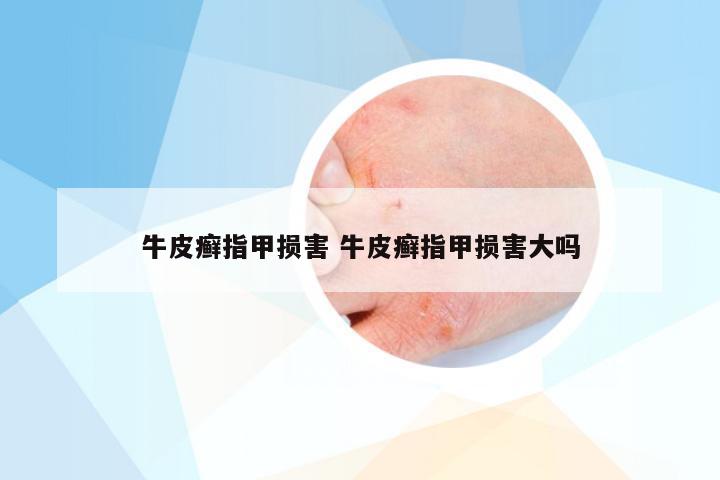 牛皮癣指甲损害 牛皮癣指甲损害大吗