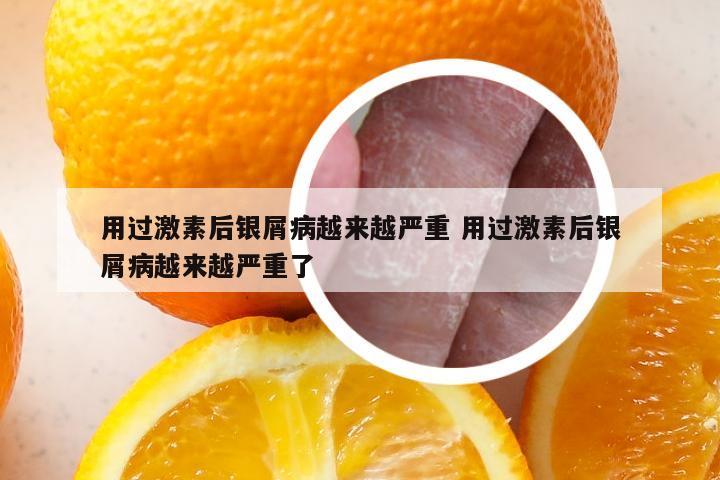 用过激素后银屑病越来越严重 用过激素后银屑病越来越严重了