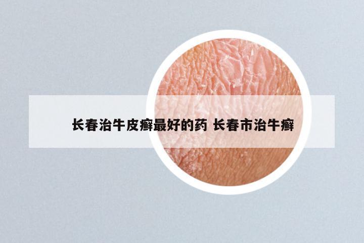 长春治牛皮癣最好的药 长春市治牛癣