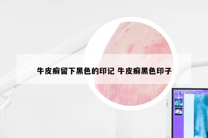 牛皮癣留下黑色的印记 牛皮癣黑色印子