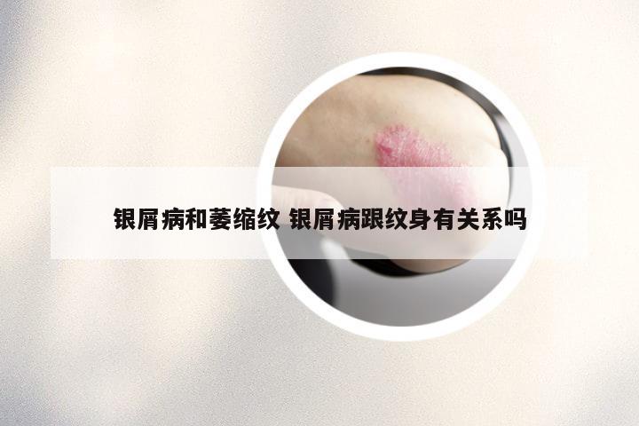 银屑病和萎缩纹 银屑病跟纹身有关系吗