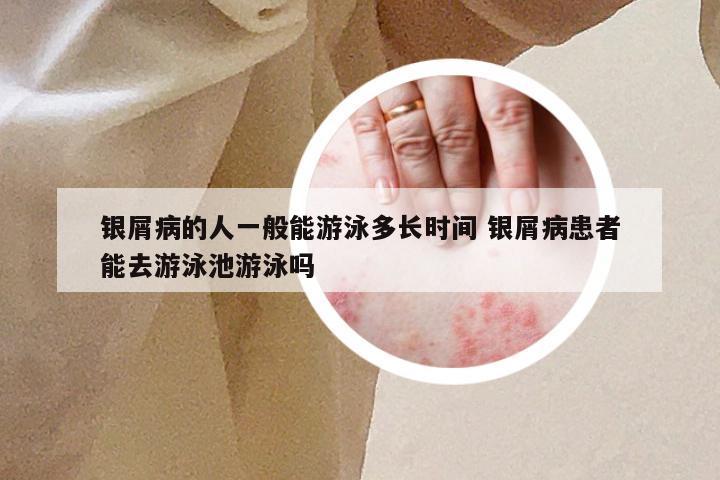 银屑病的人一般能游泳多长时间 银屑病患者能去游泳池游泳吗